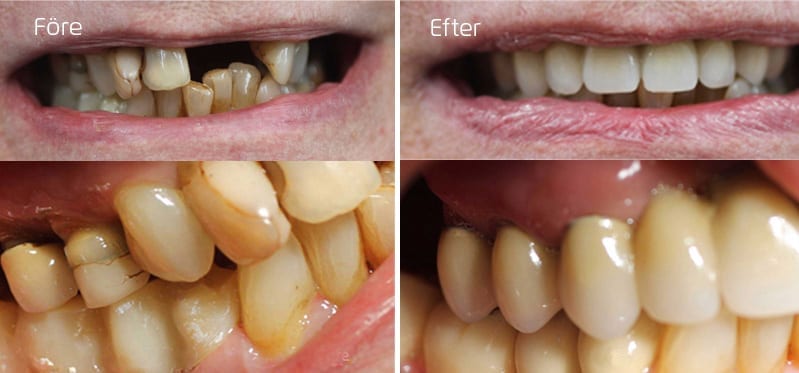 Före och efter full tandbro i överkäke och en delbro i underkäken