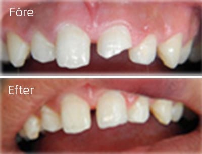 Före och efter lagning med compist framtand