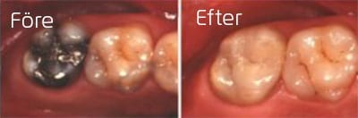 Före och efter porslinsonlay på kindtand