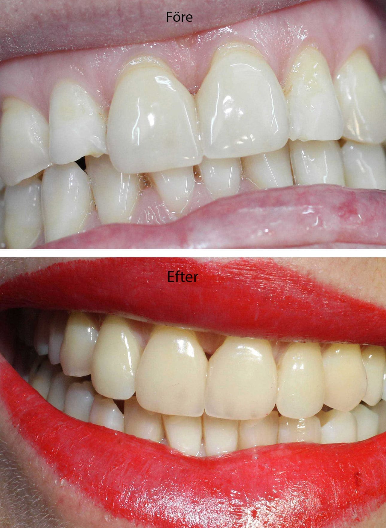 Före och efter porslinsfasader på två sidotänder (lateraler) i överkäken