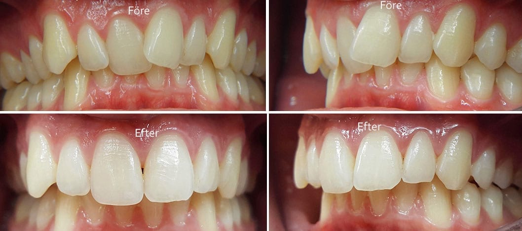 Före och efter tandställning i överkäke